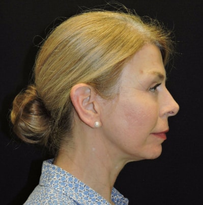 Mini Facelift Patient After Photo Nashville