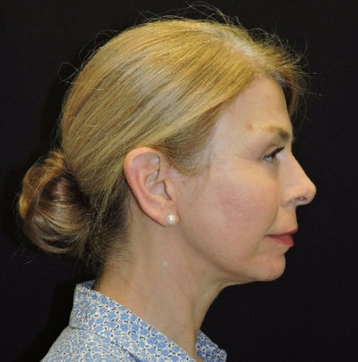 Mini Facelift Patient After Photo