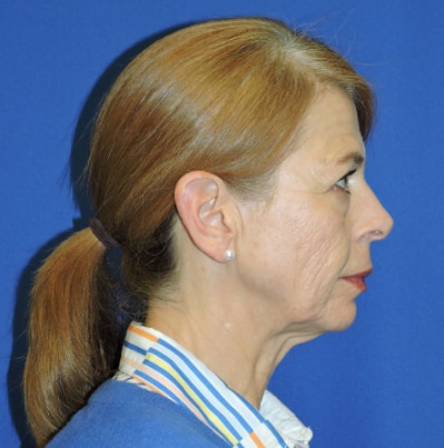 Mini Facelift Patient Before Photo