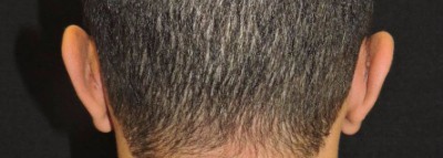 Ear Reshaping Patient After Photo Nashville