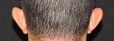 Ear Reshaping Patient Before Photo Nashville