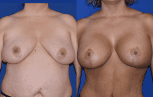 Patient before after photos of Mastopexy with Implants