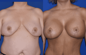 Patient before after photos of Mastopexy with Implants Nashville