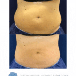 Result after two full CoolSculpting treatments