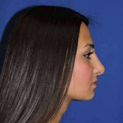 Rhinoplasty Patient After Photo