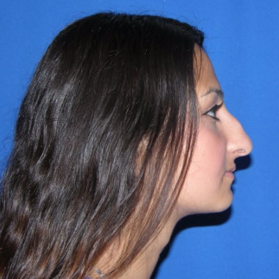 Rhinoplasty Patient Before Photo