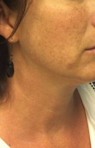 Ultherapy Patient After Photo