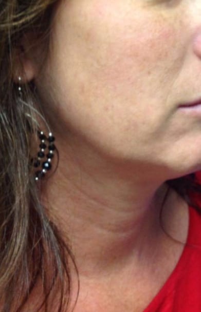 Ultherapy Patient Before Photo