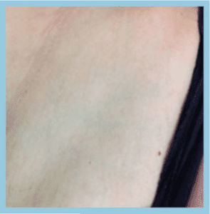 Laser hair Removal Patient After Photo Nashville