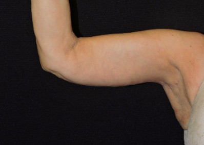 Arm Lift Patient After Photo Nashville