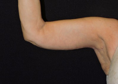 Arm Lift Patient After Photo