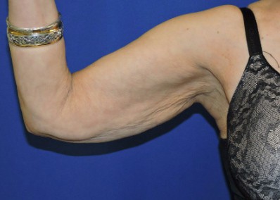 Arm Lift Patient Before Photo Nashville
