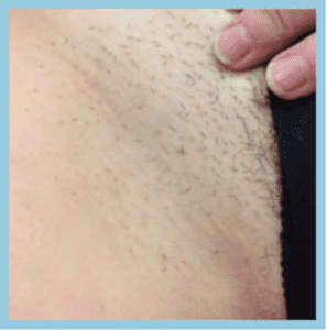Laser hair Removal Patient Before Photo