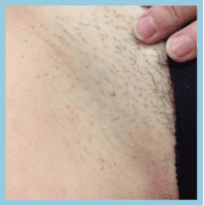 Laser Hair Removal Nashville - Hair Reduction Brentwood, TN Laser Hair Removal Nashville - Hair Reduction Brentwood, TN