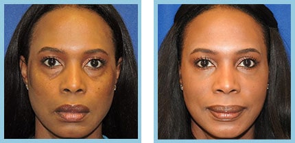 Facial Fillers Patient Before and After Photos