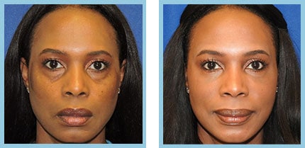Facial Fillers Patient Before and After Photos Nashville