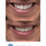 Before and after Botox Lip Flip by Chrissy Handly, RN – Cool Springs Plastic Surgery