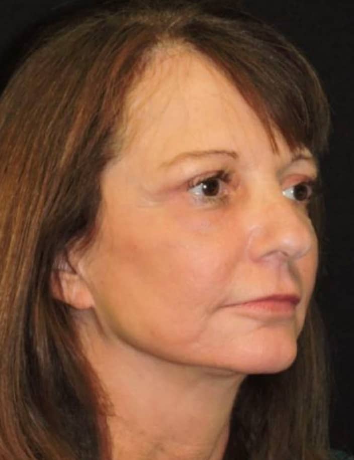 Fractionated Co2 Laser Patient After Photo Nashville