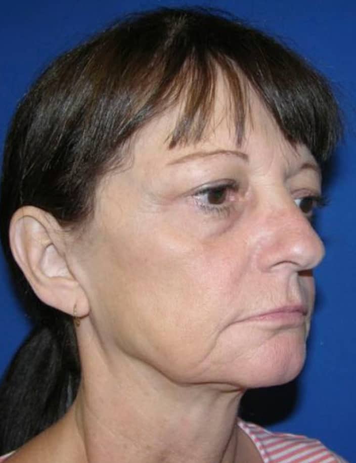 Fractionated Co2 Laser Patient Before Photo Nashville