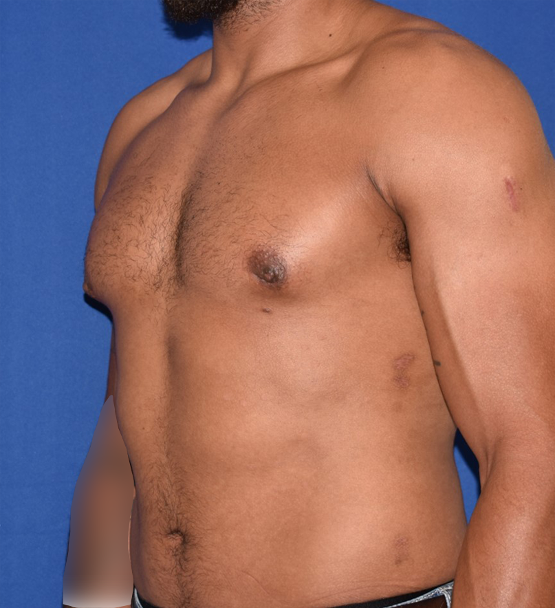 Male Breast Reduction Patient After Photo