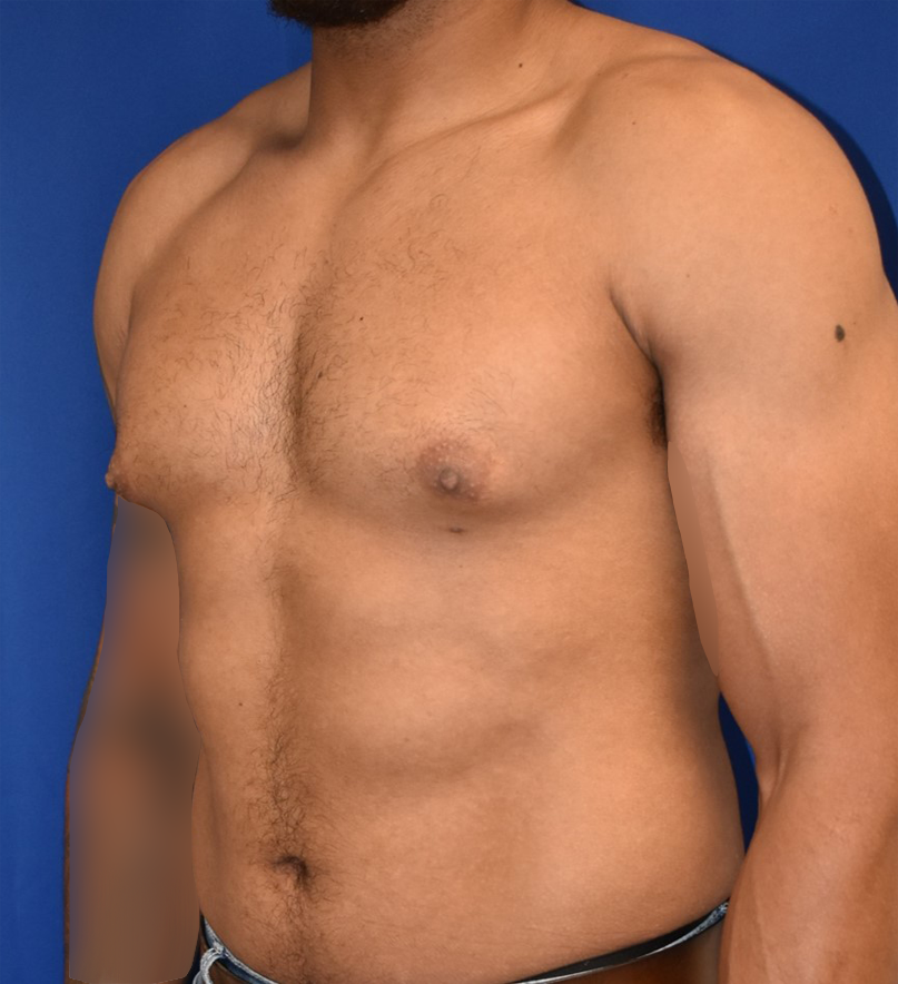 Male Breast Reduction Patient Before Photo