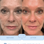 halo-bbl-stacked-laser-combo-treatment-franklin-tn-by-chrissy-at-cool-springs-plastic-surgery