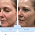 microneedling treatment by destiny at cool springs plastic surgery