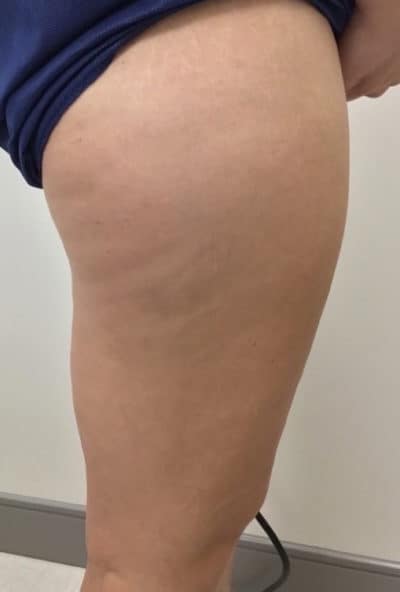 Sculptra Patient After Photo Nashville