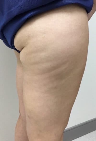 Sculptra Patient Before Photo Nashville