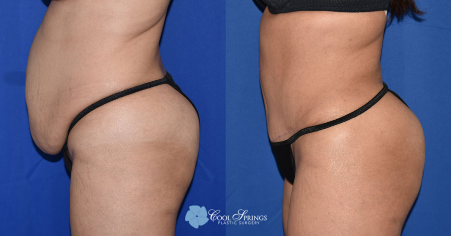 Tummy Tuck Patient - Before After Photos - Cool Springs Plastic Surgery in Nashville