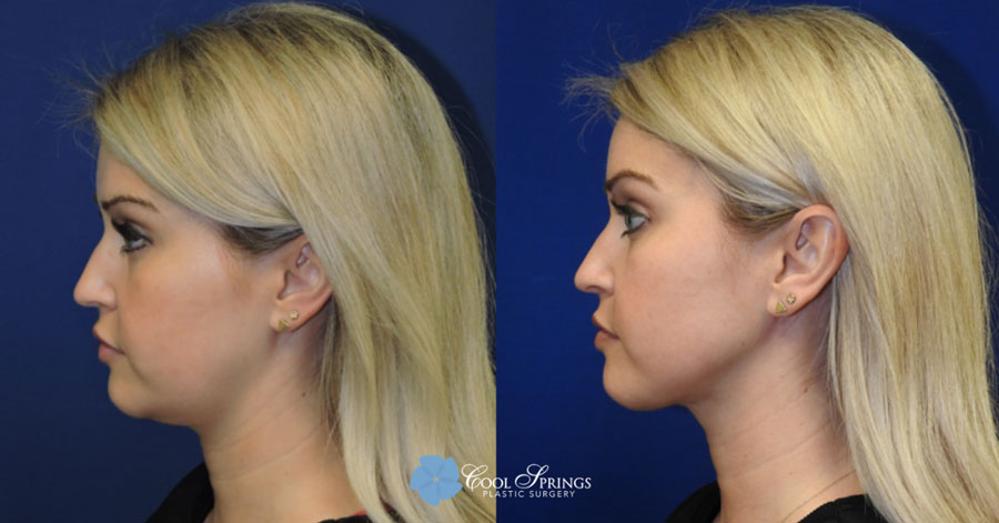 Chin Liposuction Patient - Before After Photos - Cool Springs Plastic Surgery in Nashville