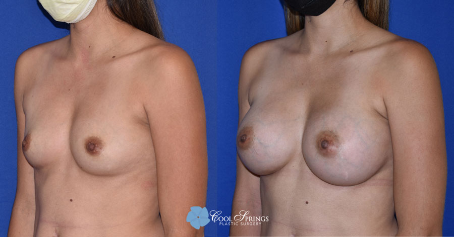 Breast Augmentation Patient - Before After Photos - Cool Springs Plastic Surgery in Nashville