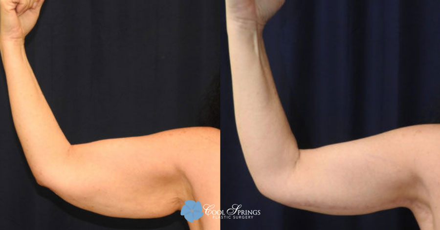 Arm Lift Patient - Before After Photos - Cool Springs Plastic Surgery in Nashville