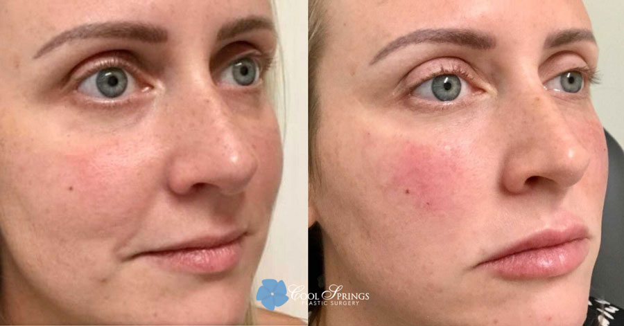 Dermal Filler Patient - Before After Photos - Cool Springs Plastic Surgery in Nashville