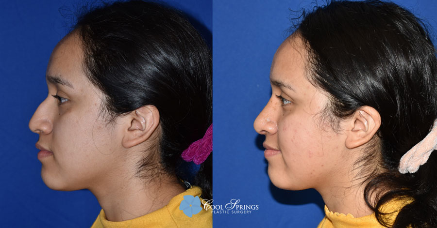 Rhinoplasty Patient - Before After Photos - Cool Springs Plastic Surgery in Nashville