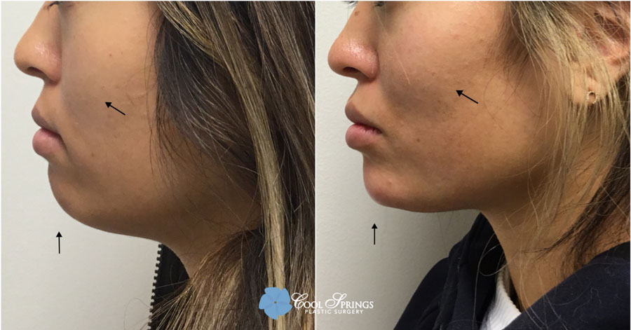 BOTOX Patient - Before After Photos - Cool Springs Plastic Surgery in Nashville