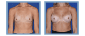 Breast Augmentation before and after photos Nashville
