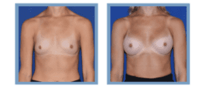 Breast Augmentation before and after photos