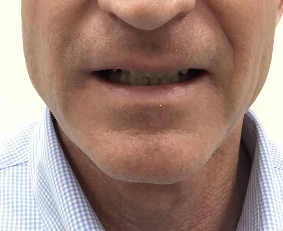 MicroLaser Peel Patient After Photo Nashville