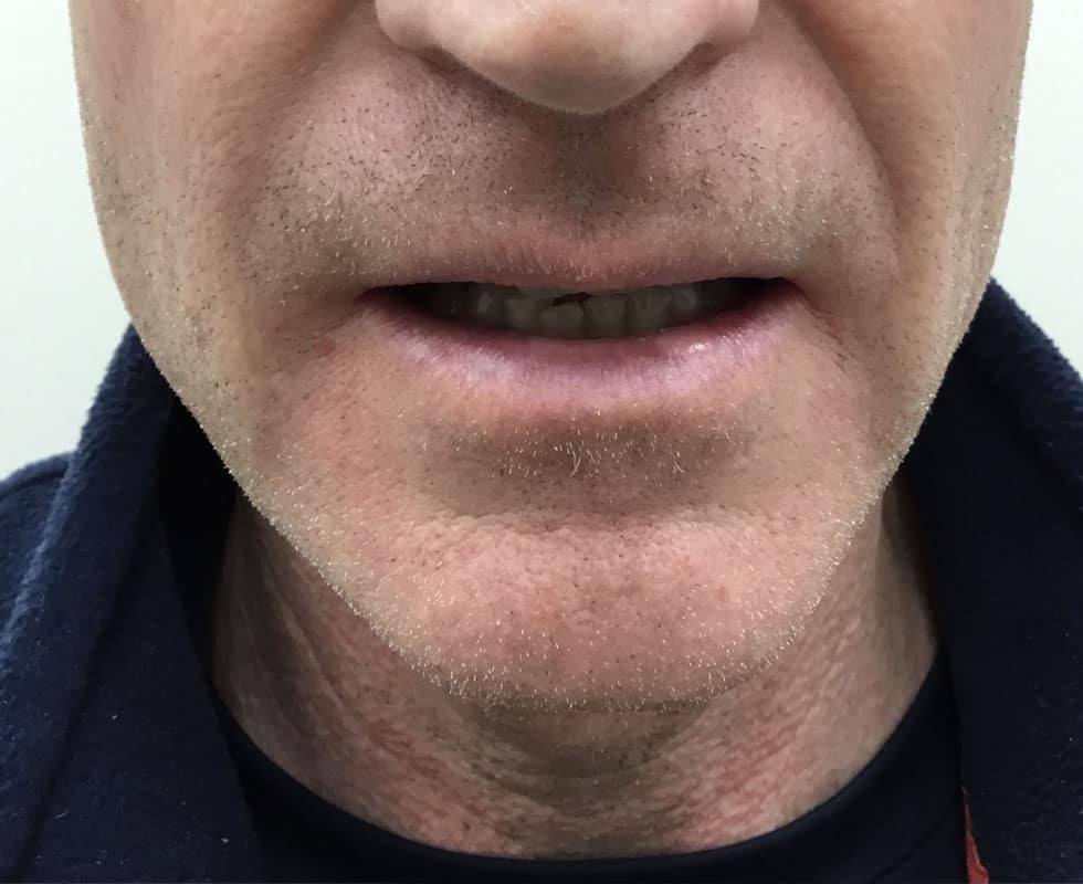 MicroLaser Peel Patient Before Photo Nashville