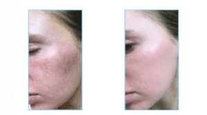 Before & After BBL Therapy Nashville