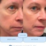 botox-filler-nashville-chrissy-handly-before-afters
