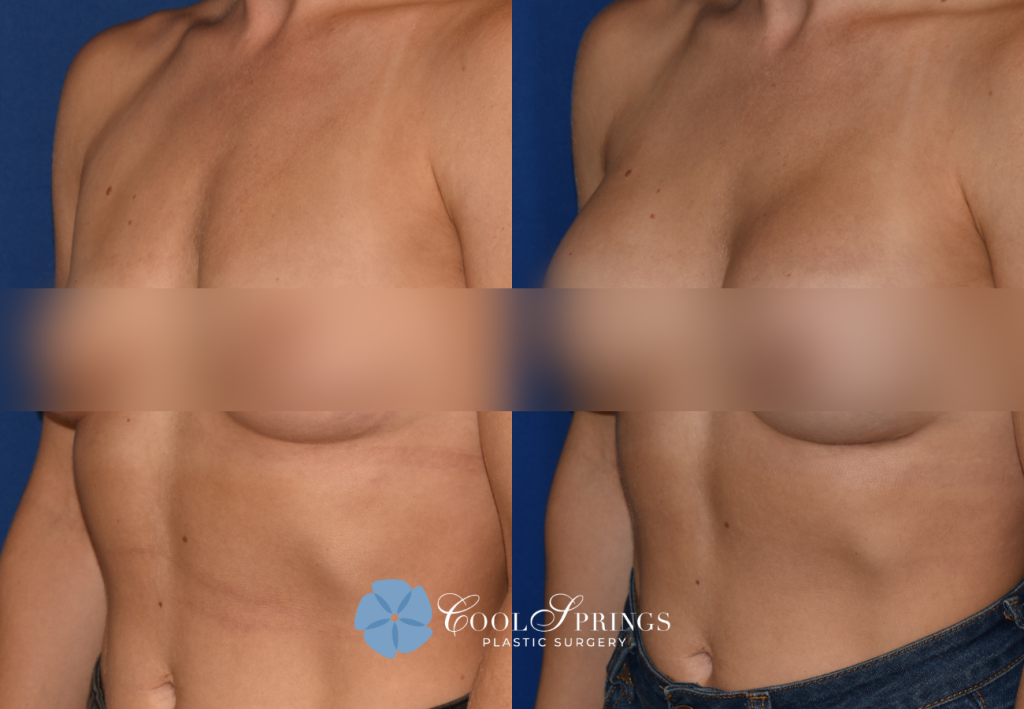 Breast Augmentation Recovery Do's and Don'ts - The Plastic Surgery Center  of Nashville