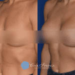 Breast Augmentation Franklin, TN
