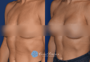Breast Augmentation Franklin, TN