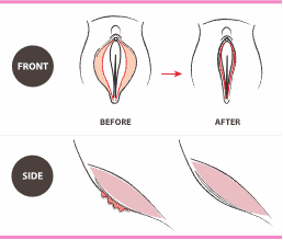 Labiaplasty illustration – Before and After