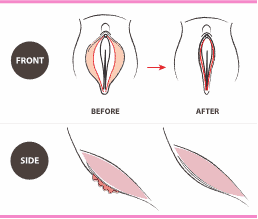 Before and After Labiaplasty Nashville
