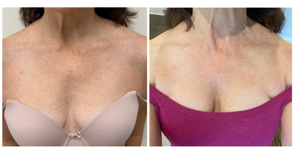 Before & After Moxi Laser Treatment Nashville