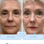 images before and after 3 bbl and 1 nano laser peel in brentwood at cool springs plastic surgery by destiny berger