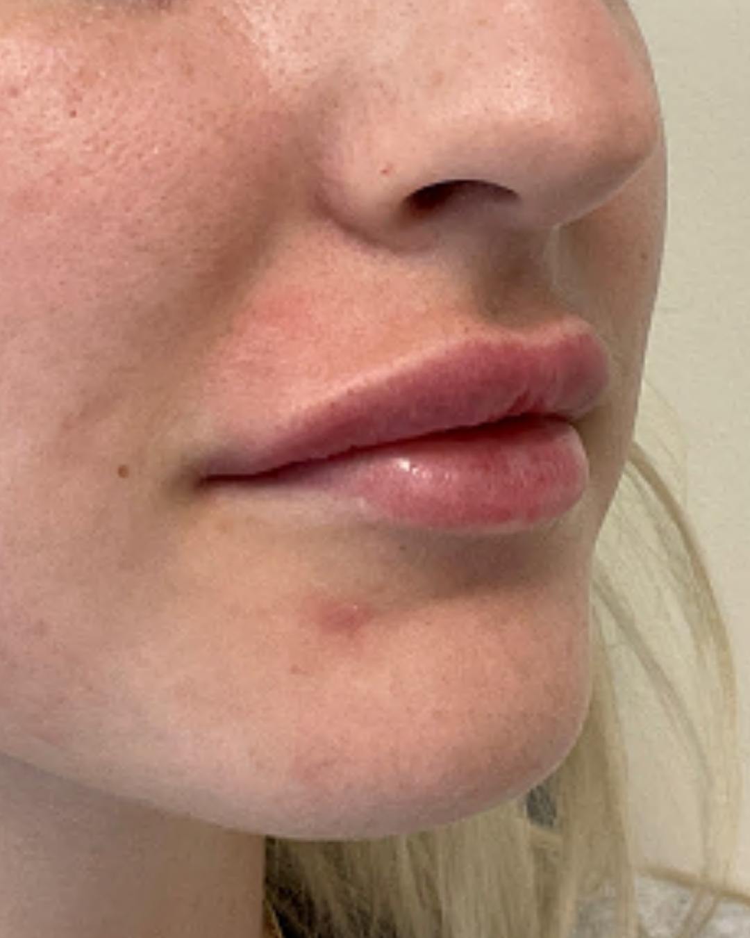 case 60 after lip filler by chrissy